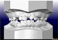 3d Tooth Model