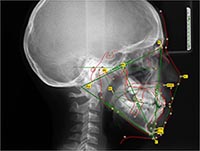 X-Ray of Skull